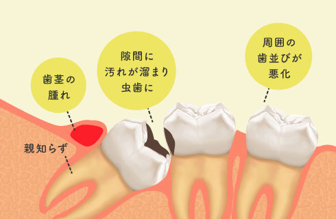 歯茎の腫れ、隙間に汚れが溜まり虫歯に、周囲の歯並びが悪化